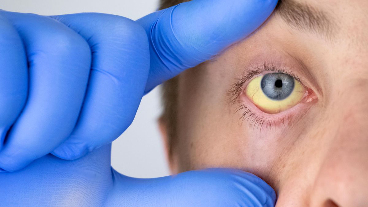 Třídy v izolaci, zákaz sportu i kroužků. Žloutenky rychle přibývá